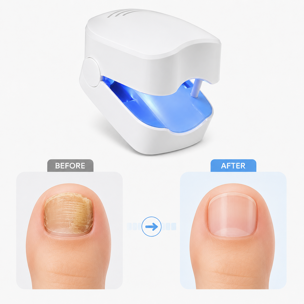Nail Fungus Laser Device